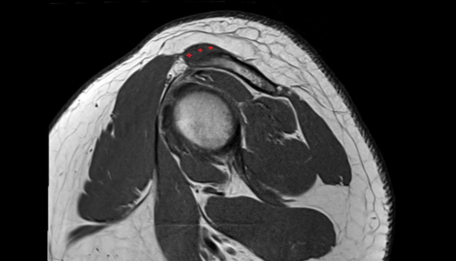 Acromioclavicular ligament sag cross sectional anatomy 3T MRI AI enhanced radiology image-img-00000-00000
