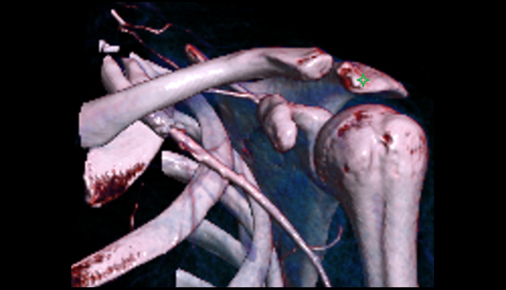 Acromion 3d ct image