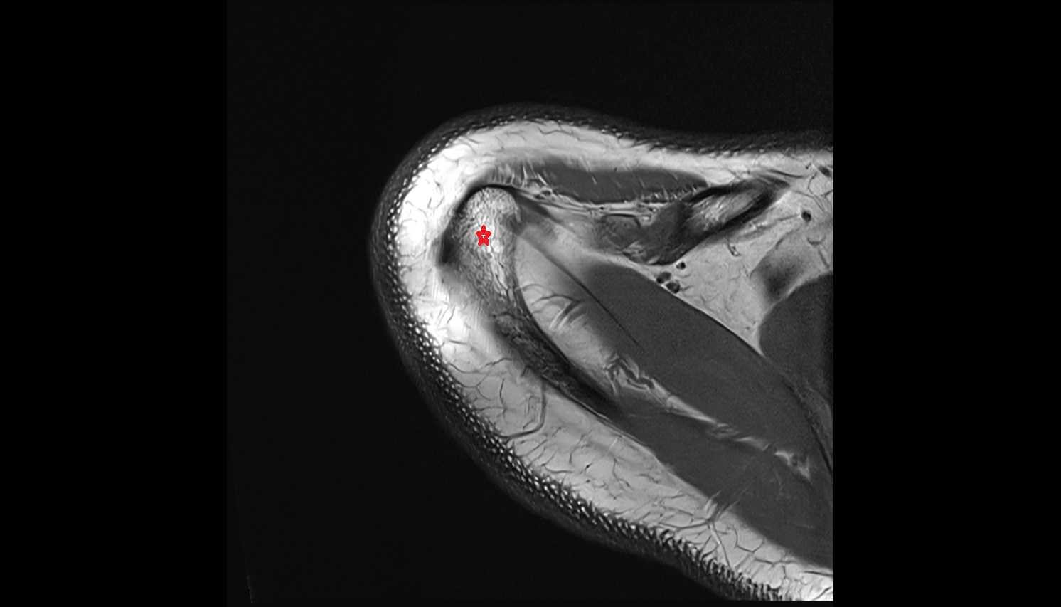 Acromion process of scapula MRI axial  image -img-00000-00000
