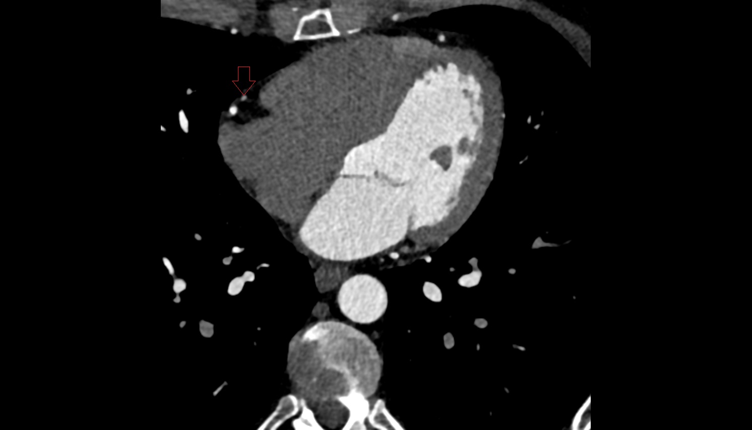 Acute marginal artery (AM)  anantomy  CT  axial image -img-00000-00000