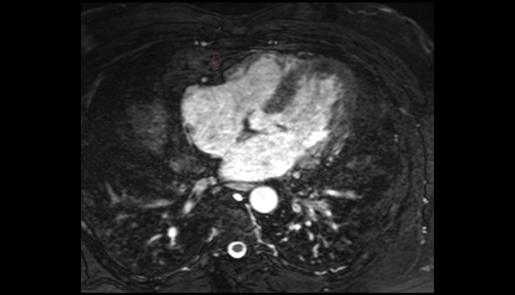 Acute marginal artery (AM) mri axial image