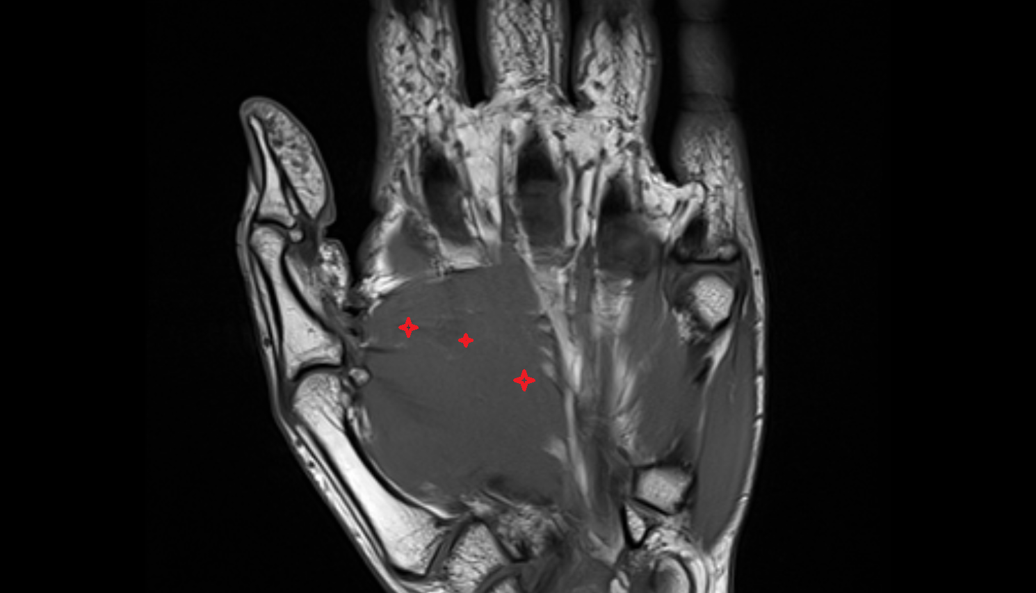 Adductor Pollicis Muscle (Oblique Head)  CORONAL cross sectional anatomy 3T MRI AI enhanced radiology image-img-00000-00000