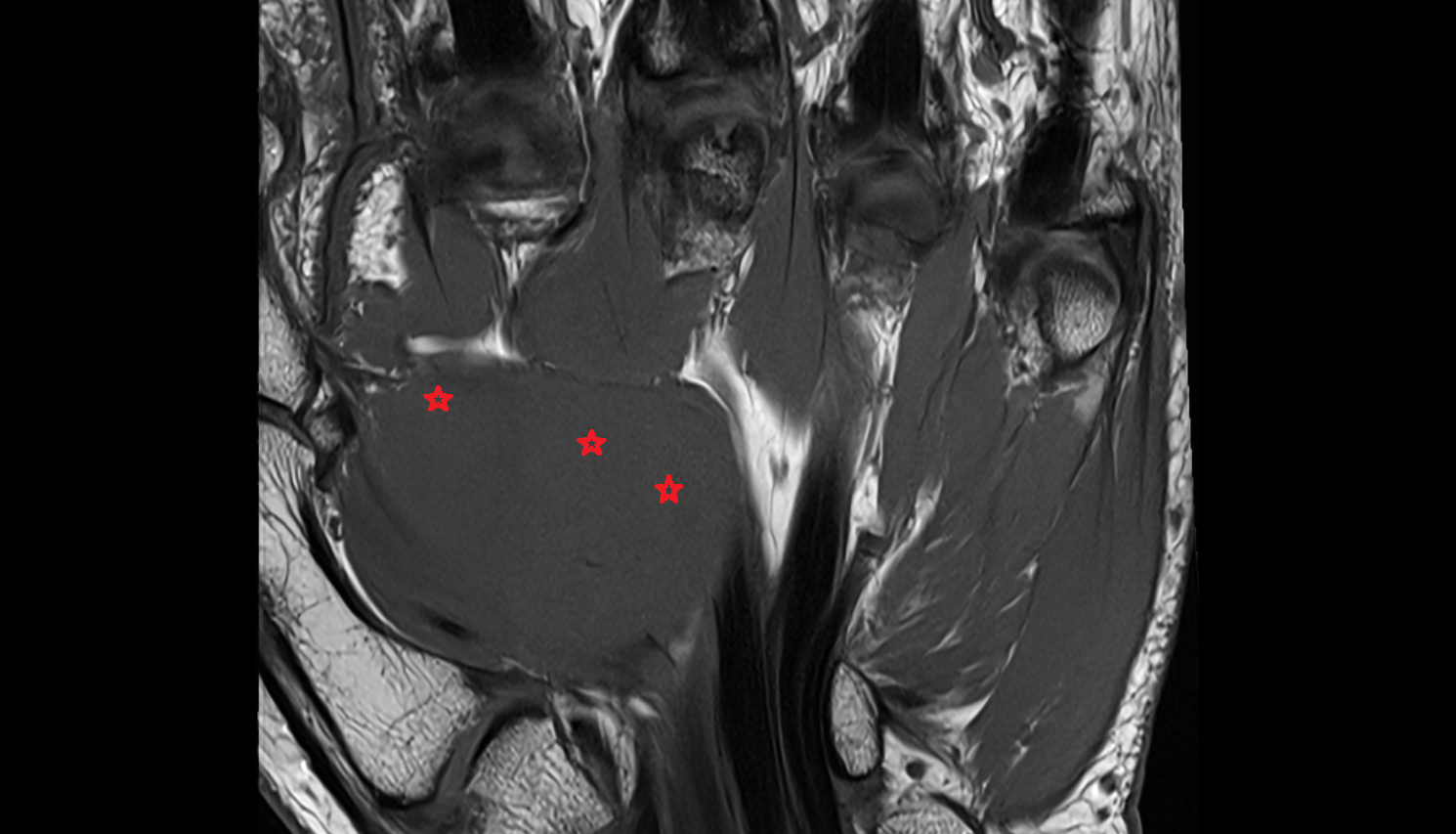 Adductor Pollicis Muscle (Oblique Head)  CORONAL cross sectional anatomy 3T MRI AI enhanced radiology image-img-00000-00000_00001