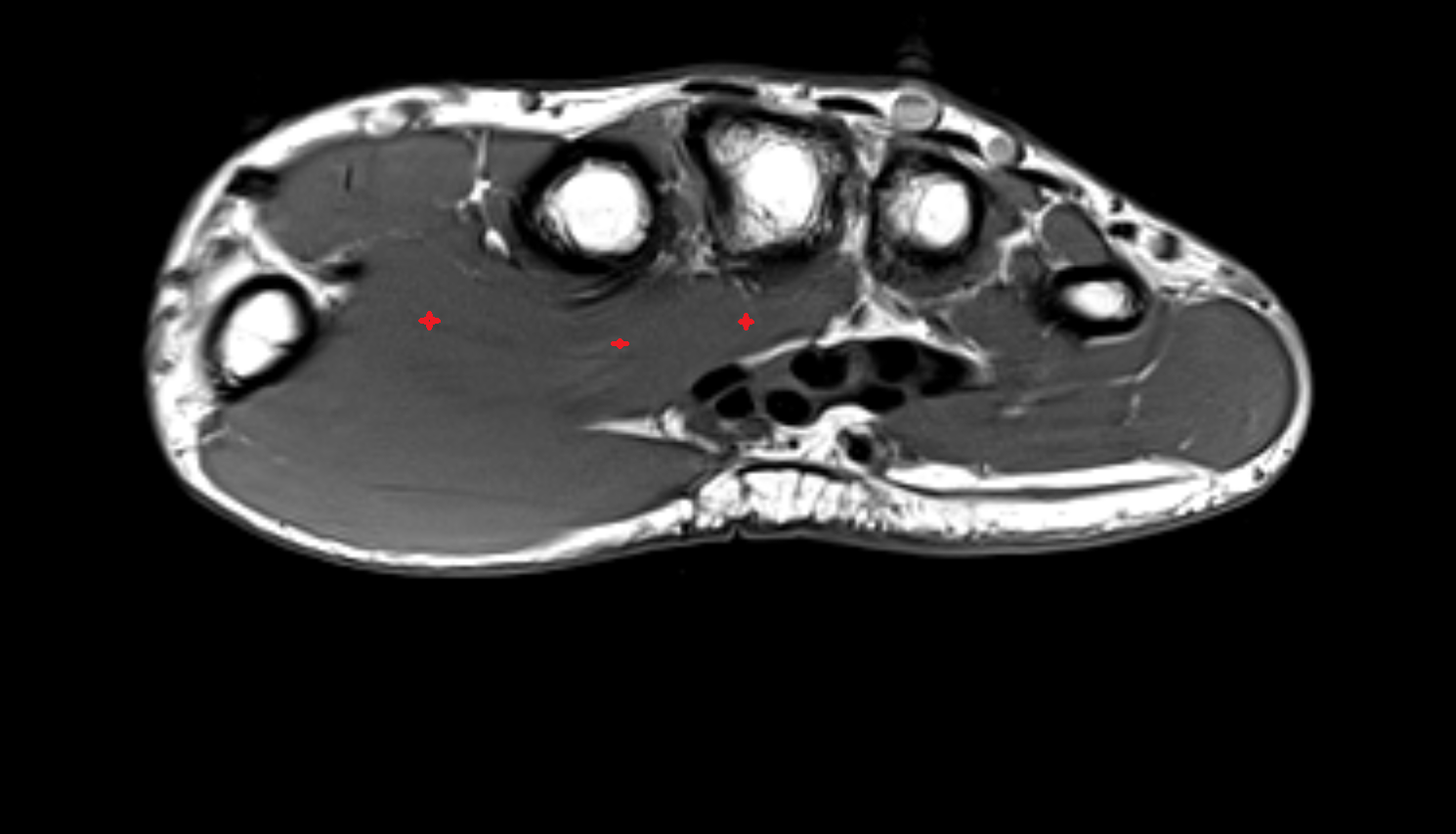Adductor Pollicis Muscle (Oblique Head)  axial cross sectional anatomy 3T MRI AI enhanced radiology image-img-00000-00000