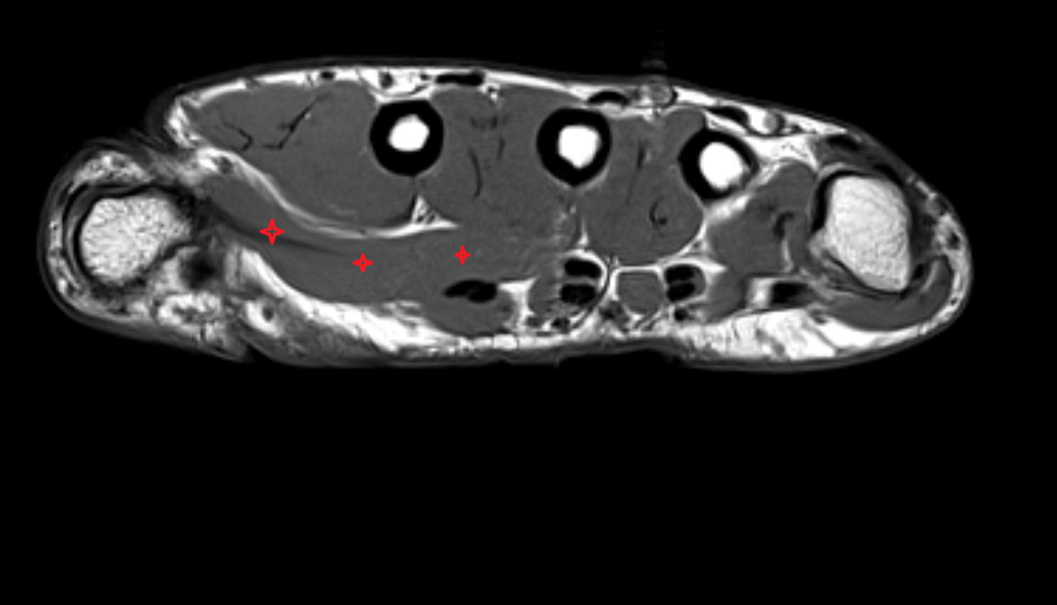 Adductor Pollicis Muscle (Transverse Head)  axial cross sectional anatomy 3T MRI AI enhanced radiology image-img-00000-00000