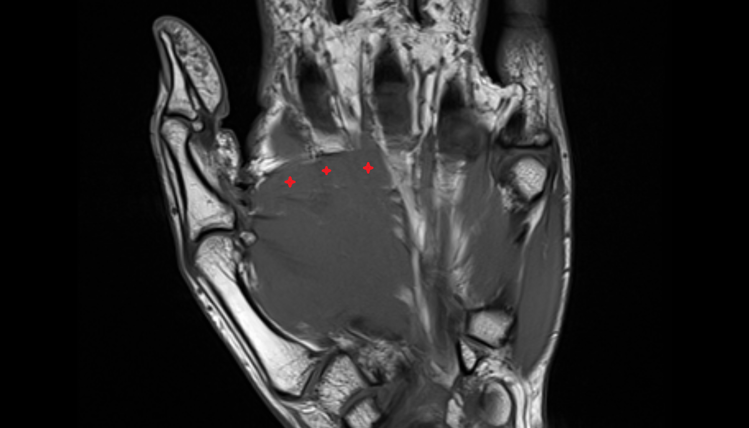 Adductor Pollicis Muscle (Transverse Head)  coronal cross sectional anatomy 3T MRI AI enhanced radiology image-img-00000-00000