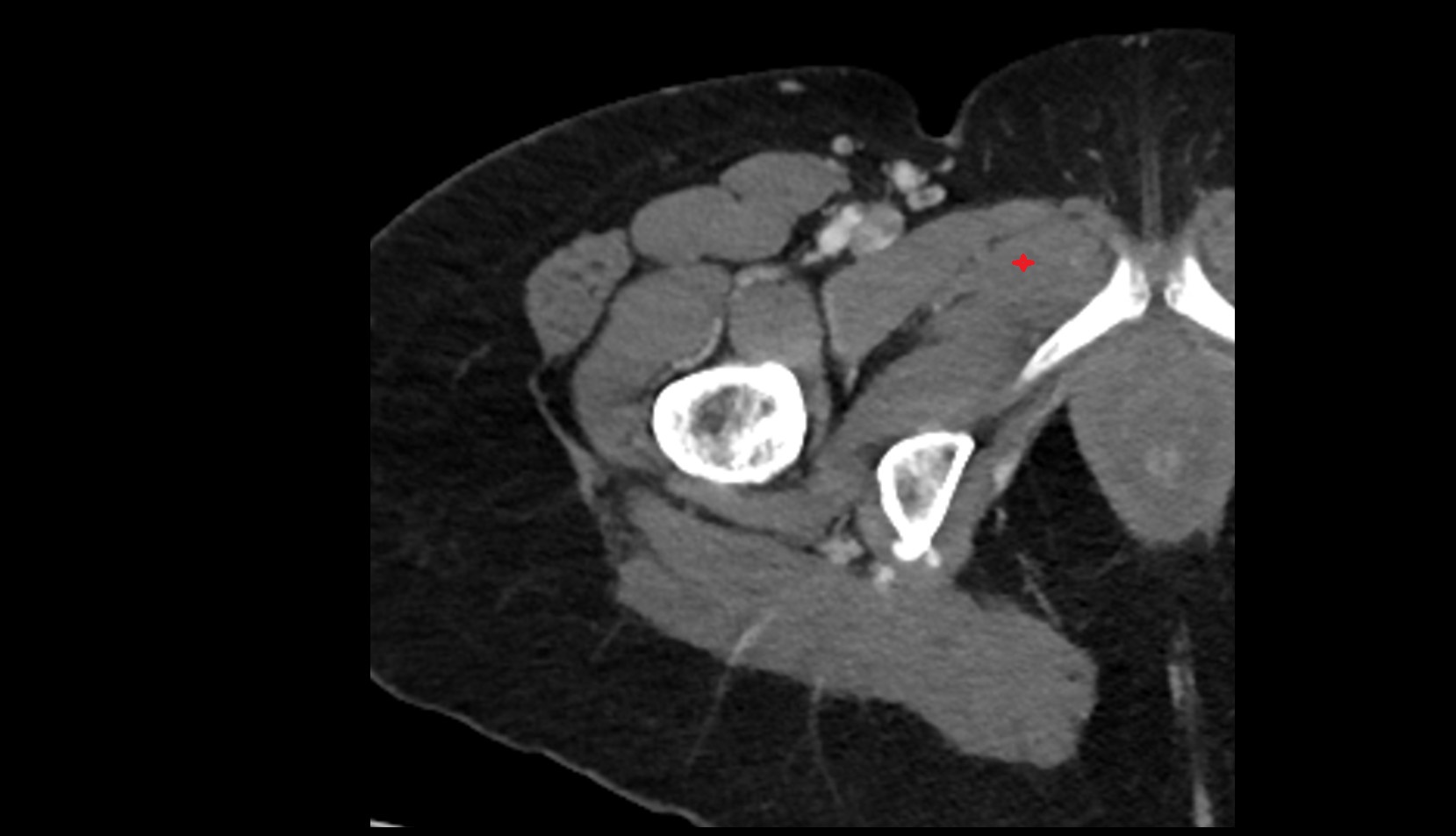 Adductor brevis muscle CT axial image