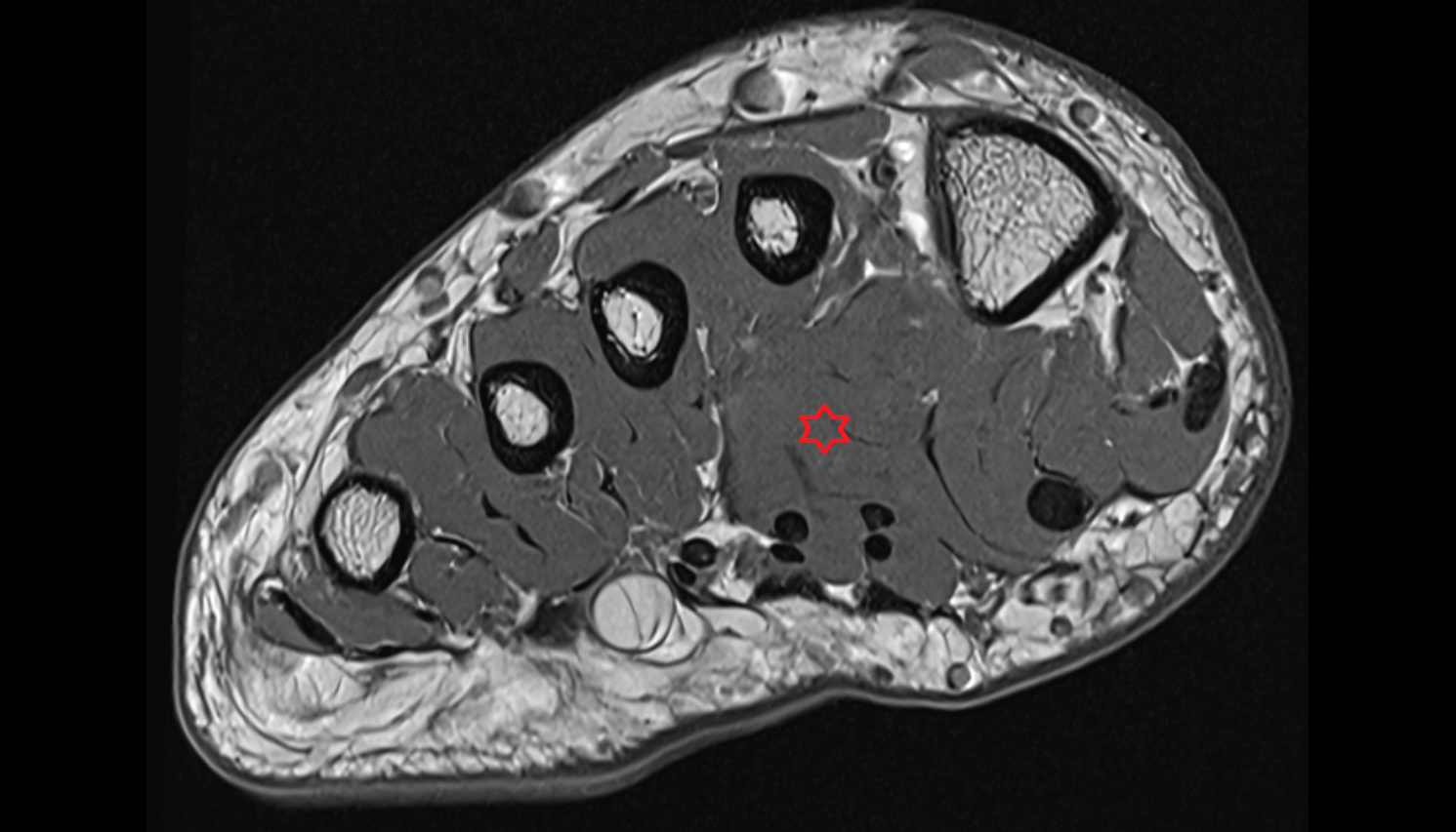 Adductor hallucis muscle axialcross sectional anatomy 3T MRI AI enhanced radiology image-img-00000-00000_00001