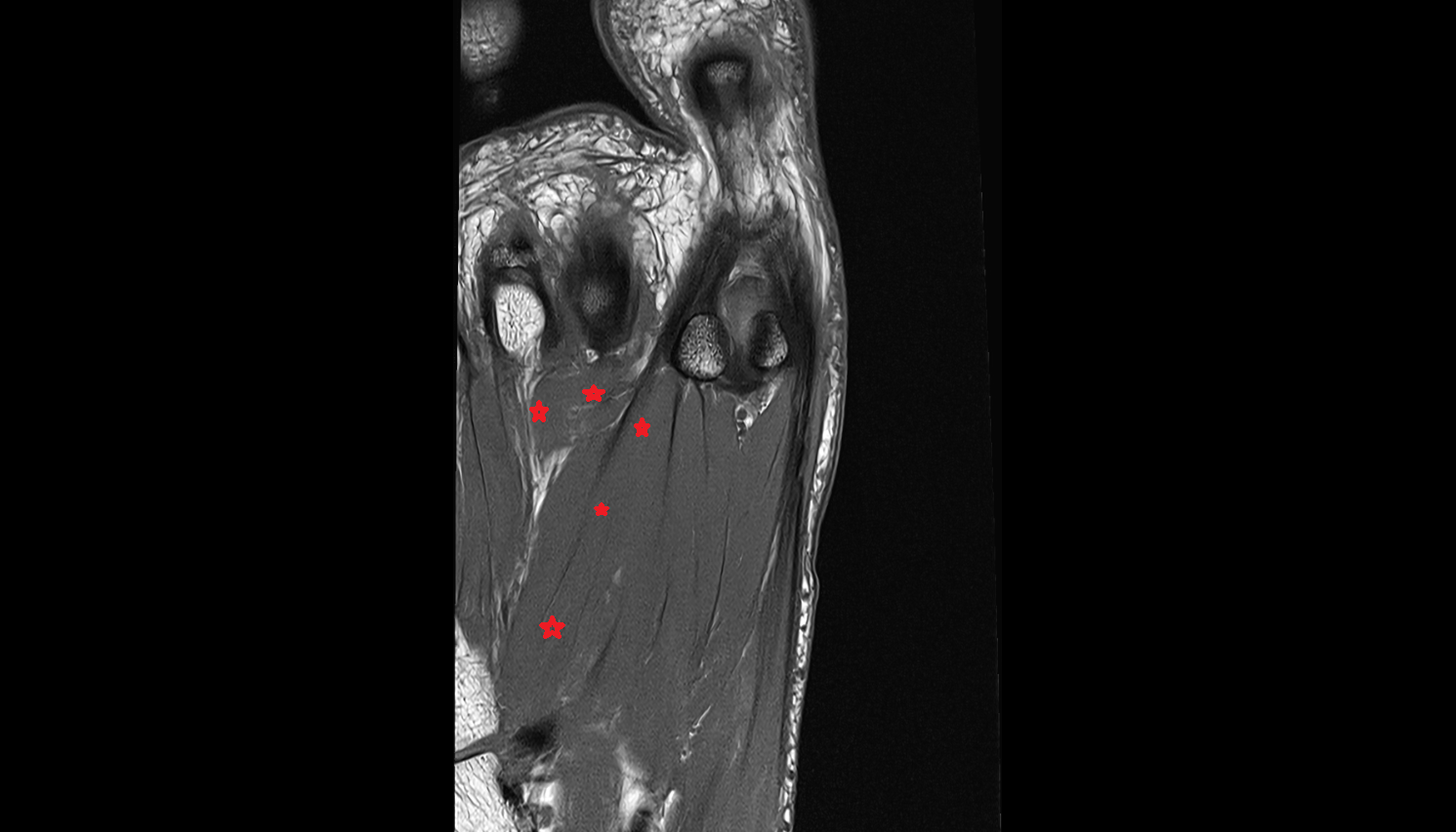 Adductor hallucis muscle coronal cross sectional anatomy 3T MRI AI enhanced radiology image-img-00000-00000