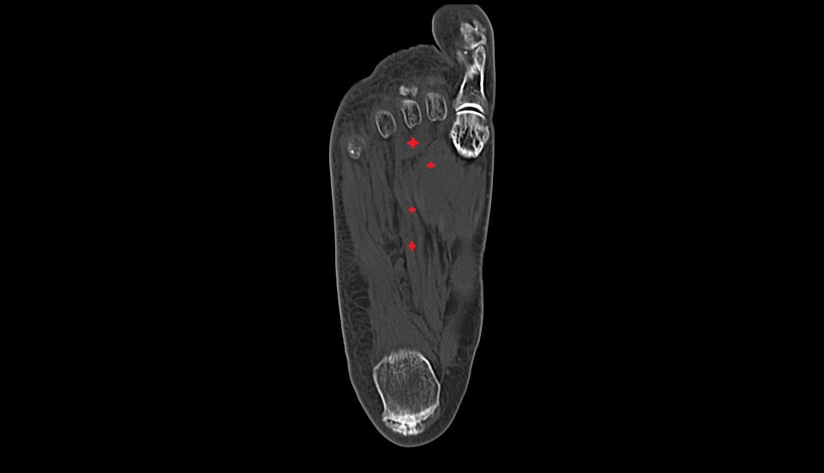 Adductor hallucis muscle ct axial image
