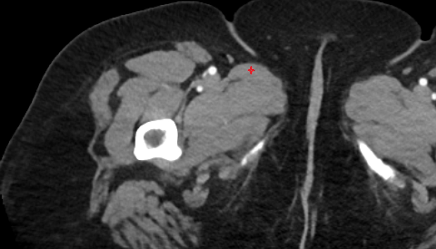 Adductor longus muscle  CT axial  anatomy  image-img-00000-00000