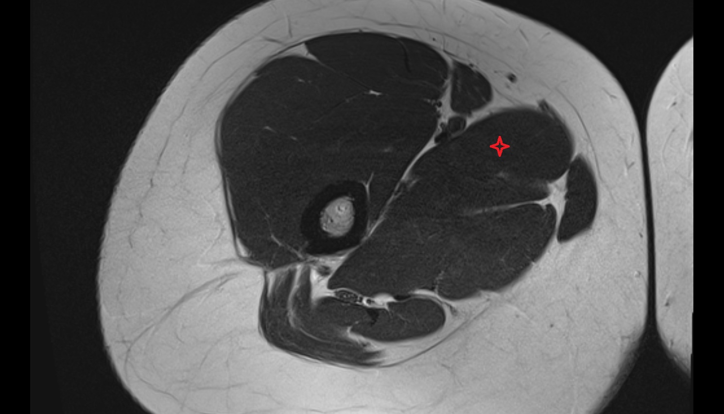 Adductor longus muscle MRI coronal anatomy image-img-00000-00000