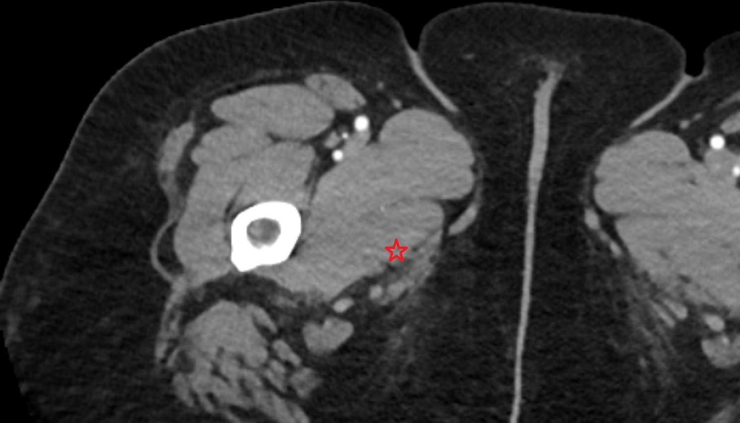 Adductor magnus muscle CT axial  anatomy  image-img-00000-00000