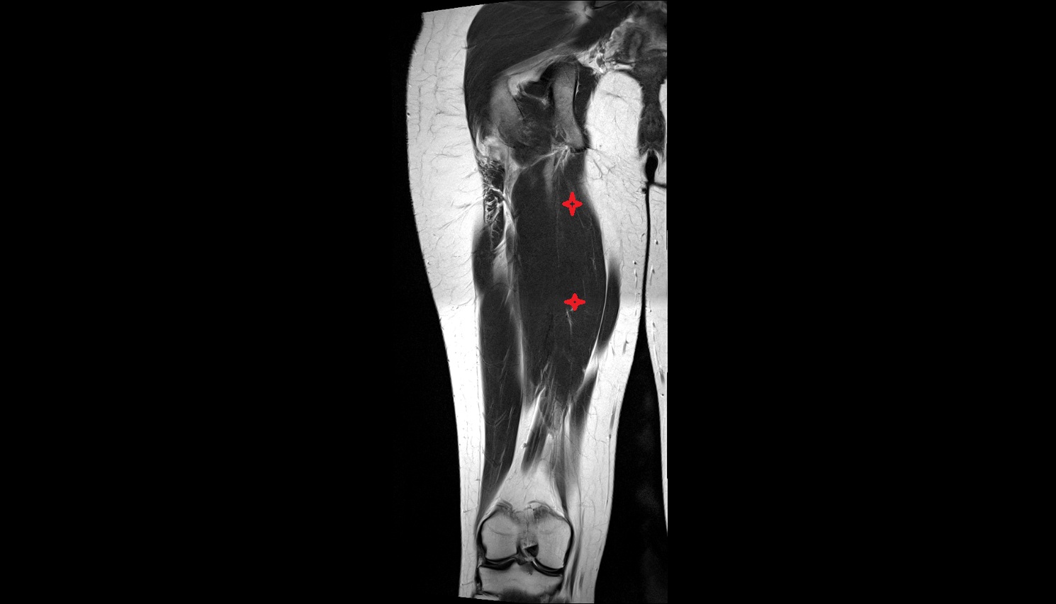 Adductor magnus muscle MRI coronal anatomy image-img-00000-00000