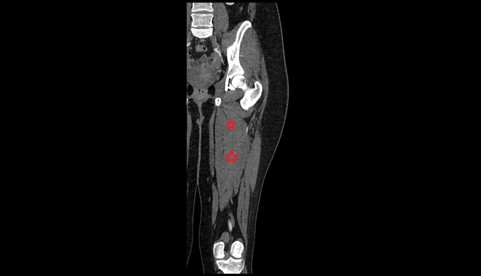 Adductor magnus muscle ct coronal