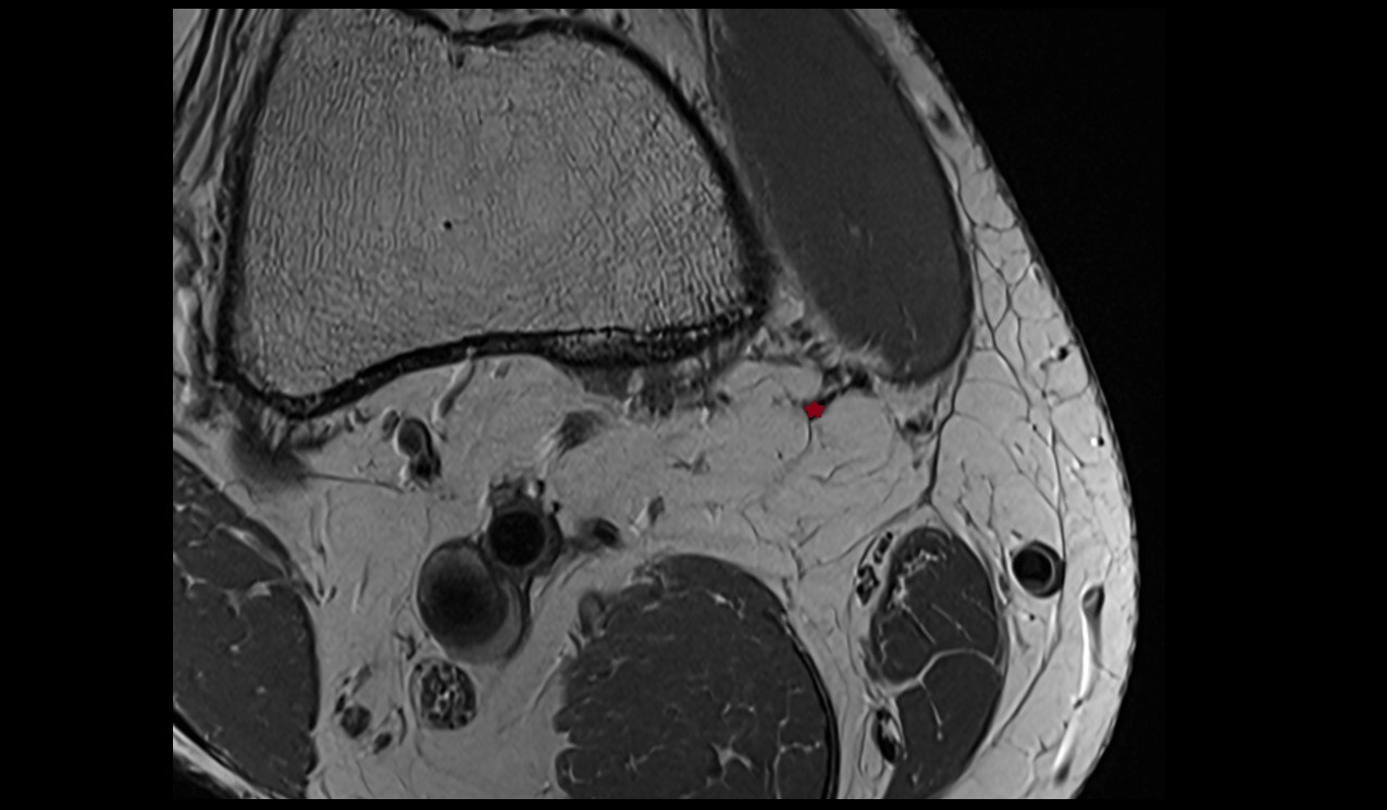Adductor magnus tendon
