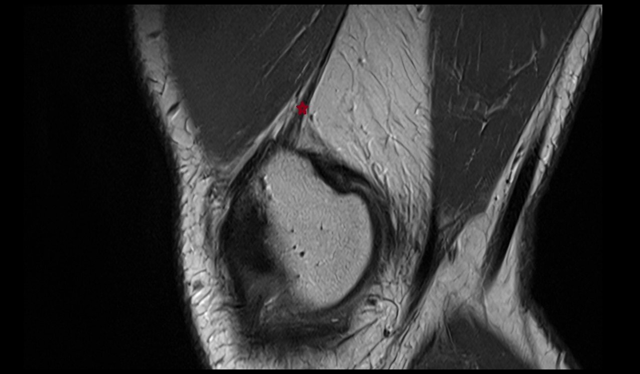 Adductor magnus tendon  sagittal mri image