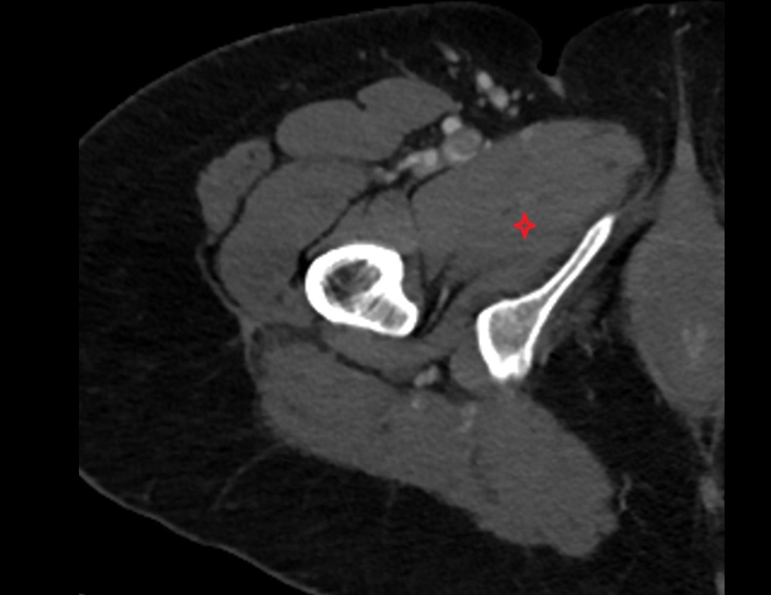 Adductor minimus muscle CT axial image