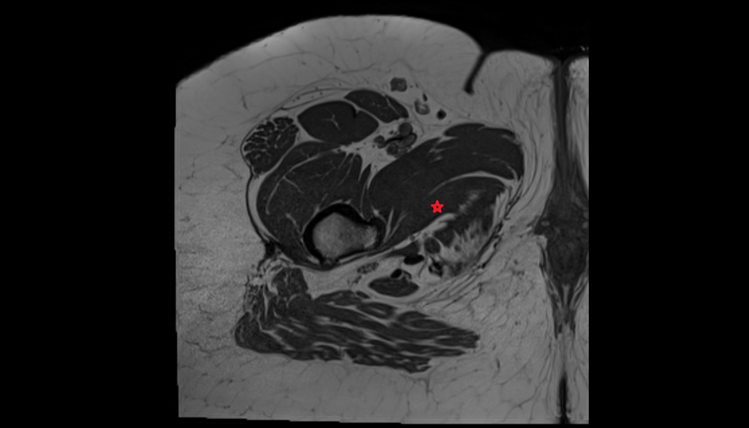 Adductor minimus muscle  MRI  axial  anatomy  image-img-00000-00000
