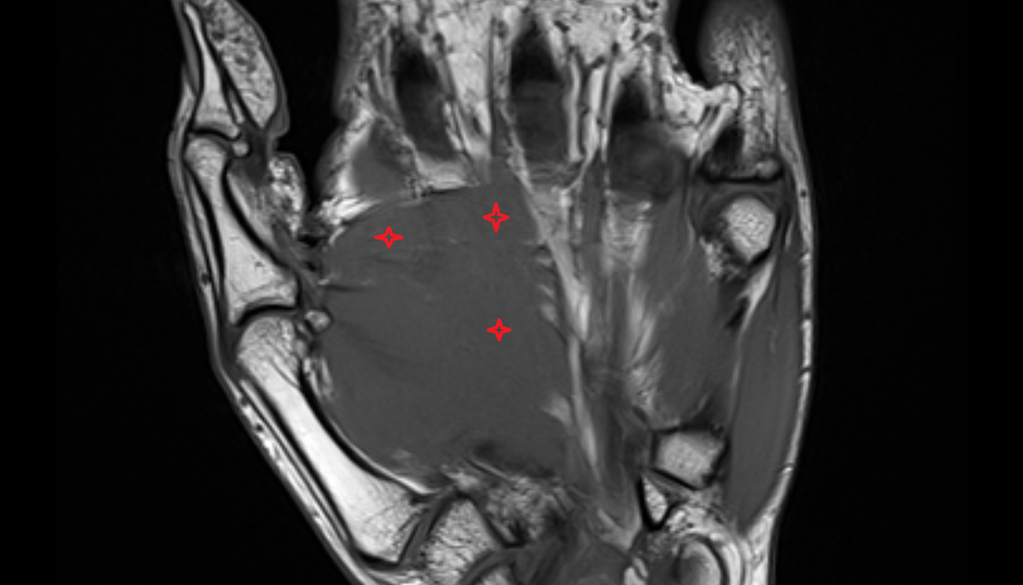 Adductor pollicis muscle  CORONAL cross sectional anatomy 3T MRI AI enhanced radiology image-img-00000-00000