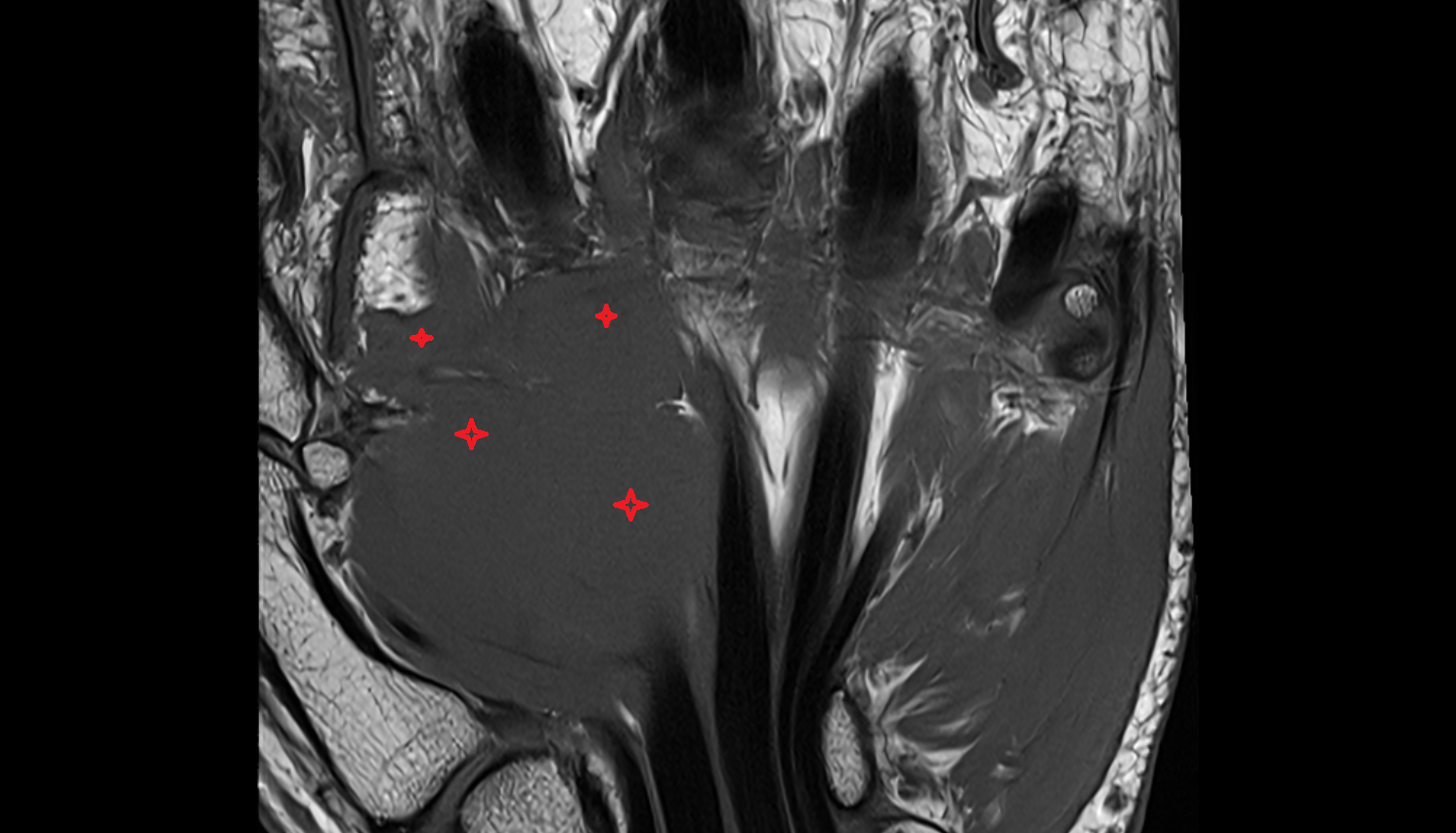 Adductor pollicis muscle  CORONAL cross sectional anatomy 3T MRI AI enhanced radiology image-img-00000-00000_00001