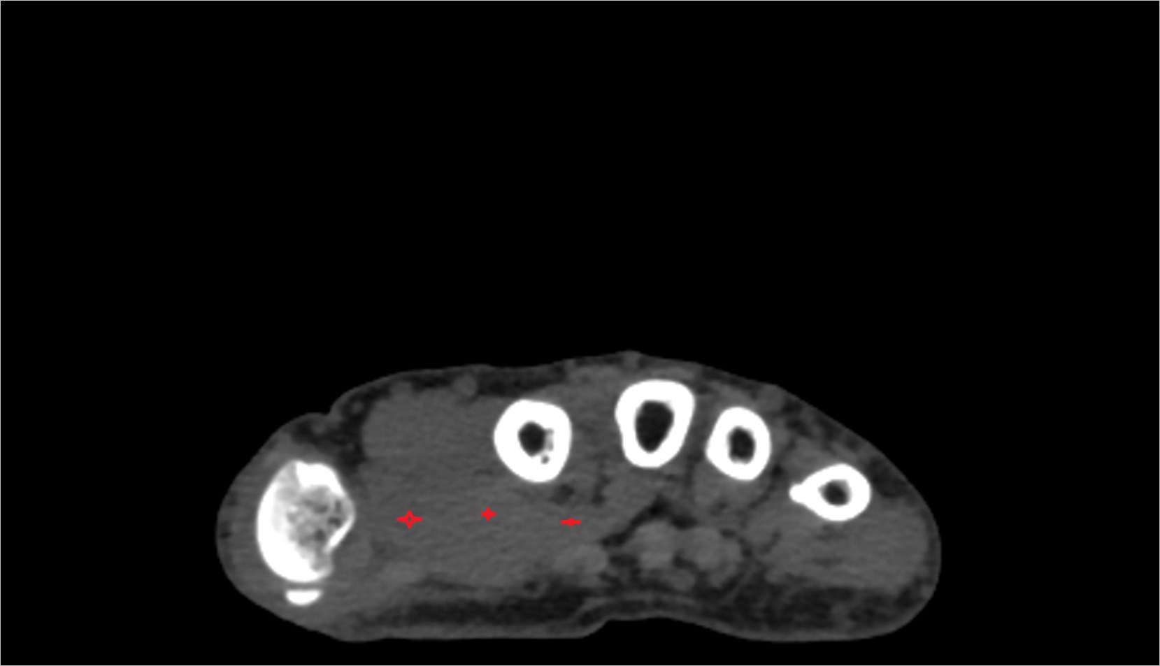 Adductor pollicis muscle CT AXIAL IMAGE