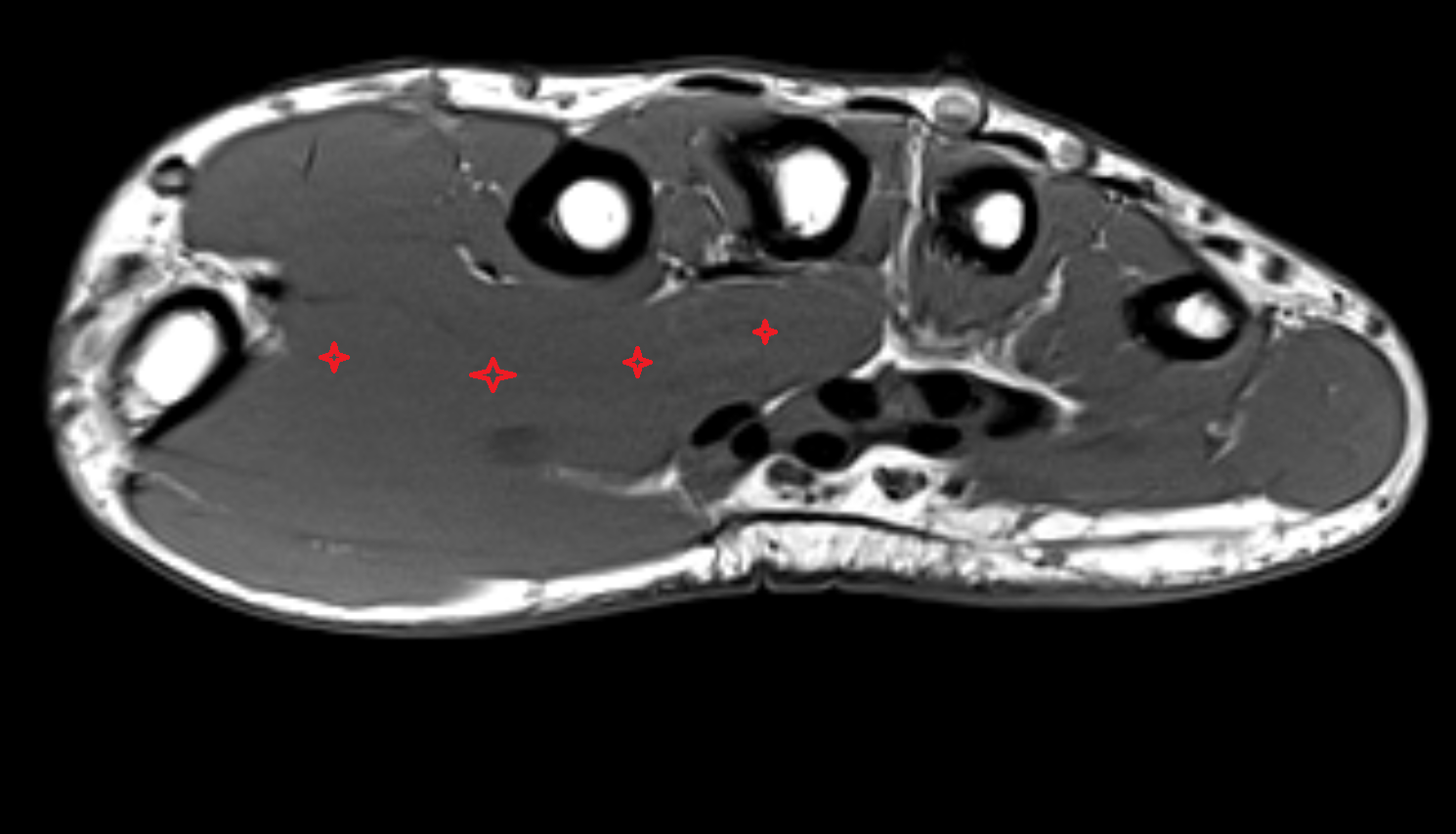 Adductor pollicis muscle  axial cross sectional anatomy 3T MRI AI enhanced radiology image-img-00000-00000