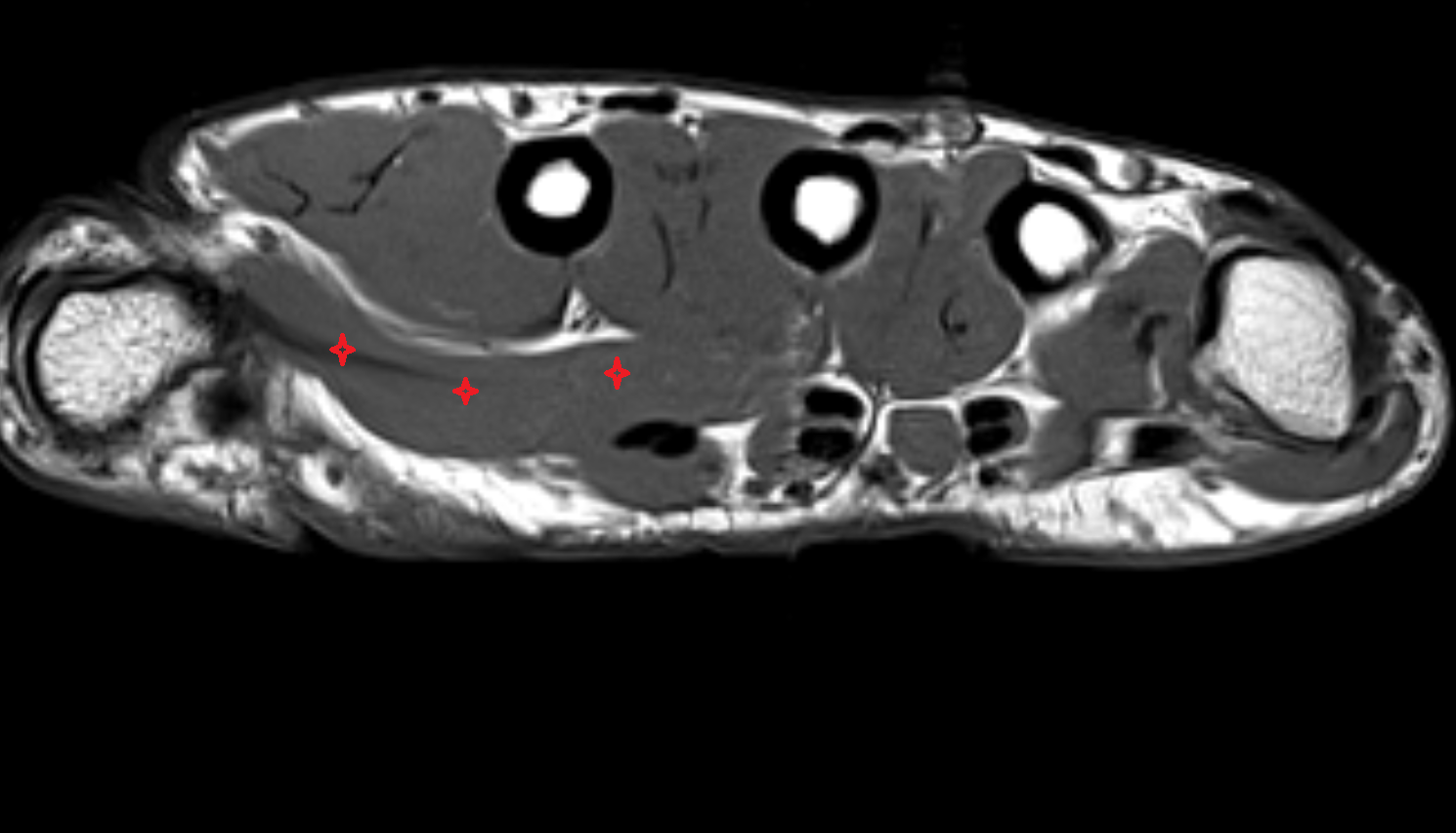 Adductor pollicis muscle  axial cross sectional anatomy 3T MRI AI enhanced radiology image-img-00000-00000_00001
