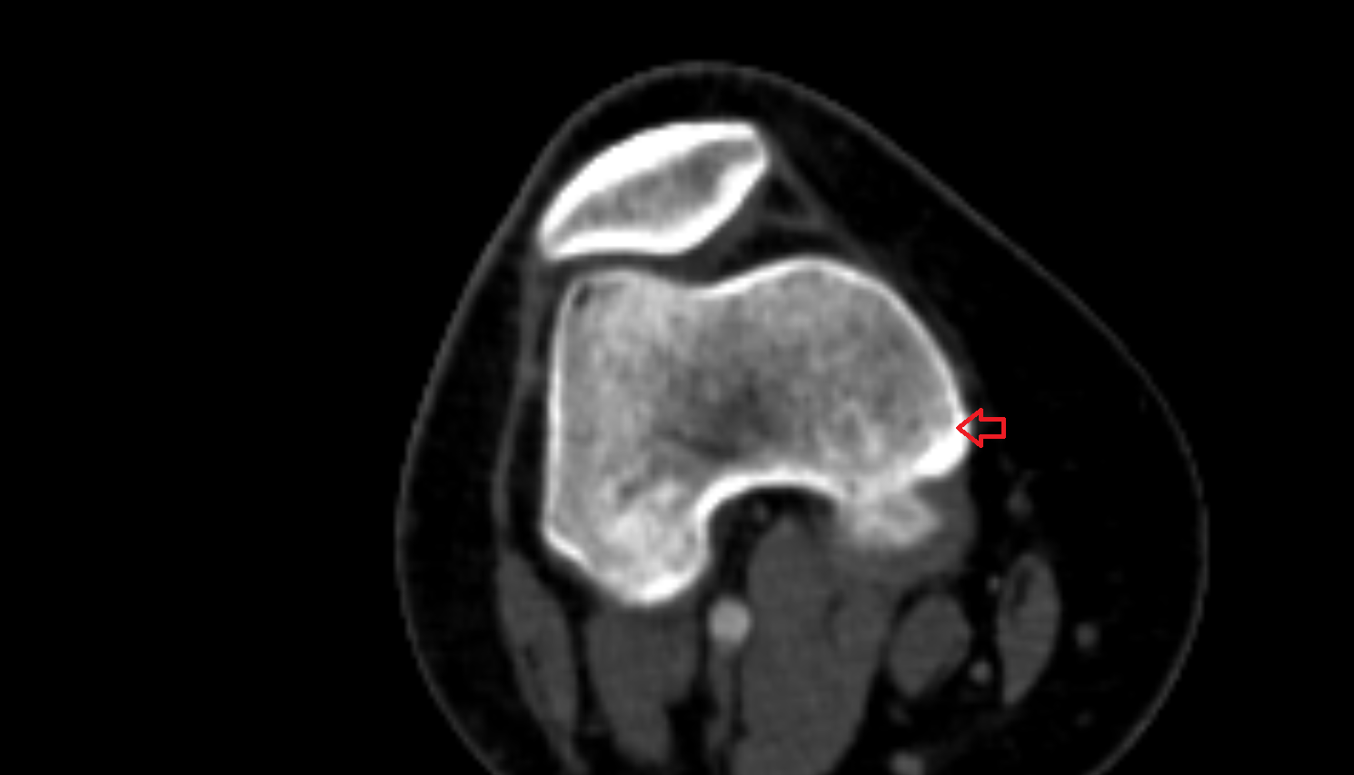 Adductor tubercle ct anatomy labelled image-img-00000-00000