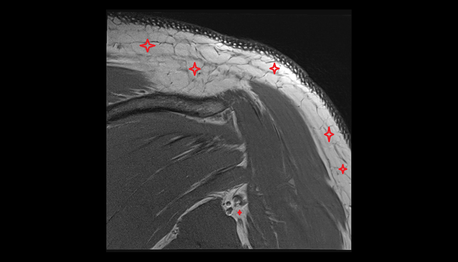 Adipose tissue shoulder  CORONAL cross sectional anatomy 3T MRI AI enhanced radiology image-img-00000-00000