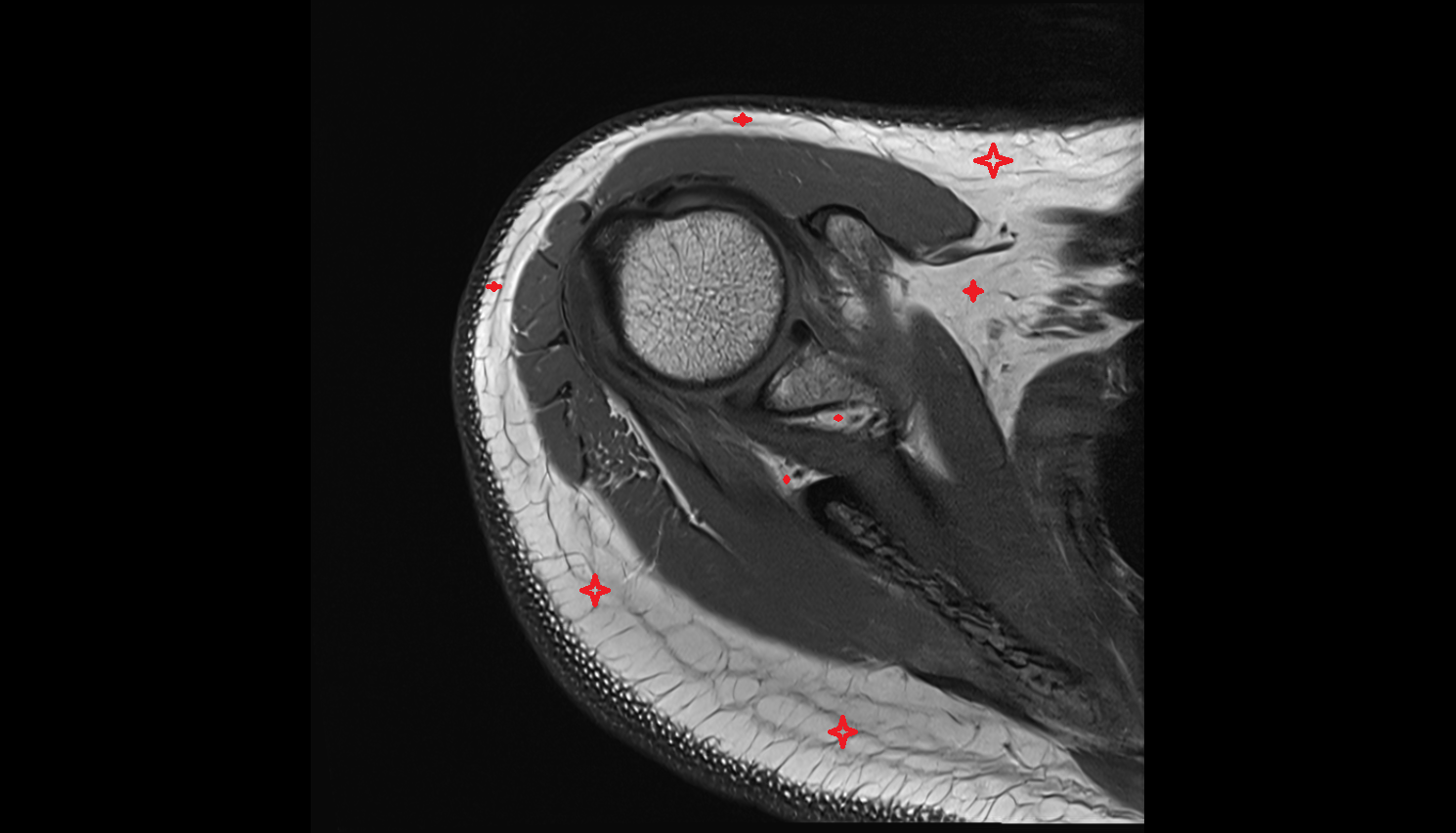 Adipose tissue shoulder axial cross sectional anatomy 3T MRI AI enhanced radiology image-img-00000-00000