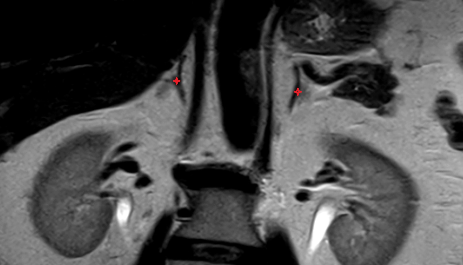 Adrenal gland  MRI coronal  image anatomy  image -img-00000-00000