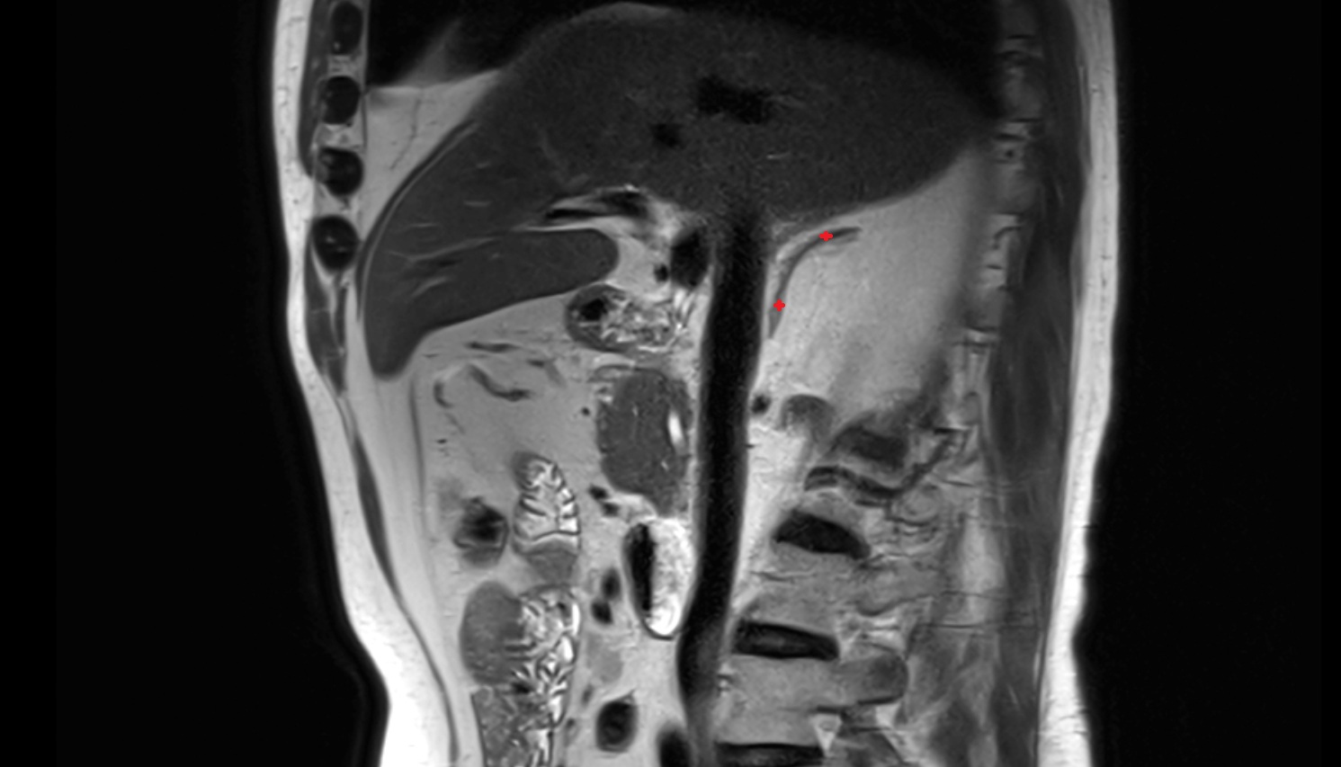 Adrenal gland  MRI sag  image anatomy  image -img-00000-00000