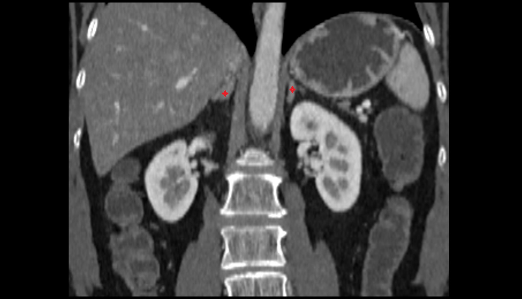 Adrenal gland ct coronal image