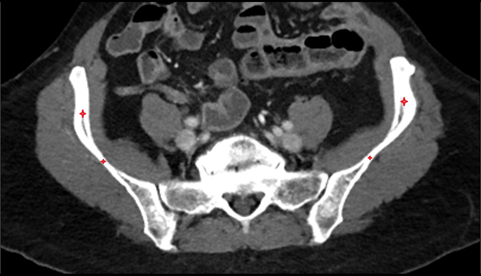 Ala of ilium CT axial  image