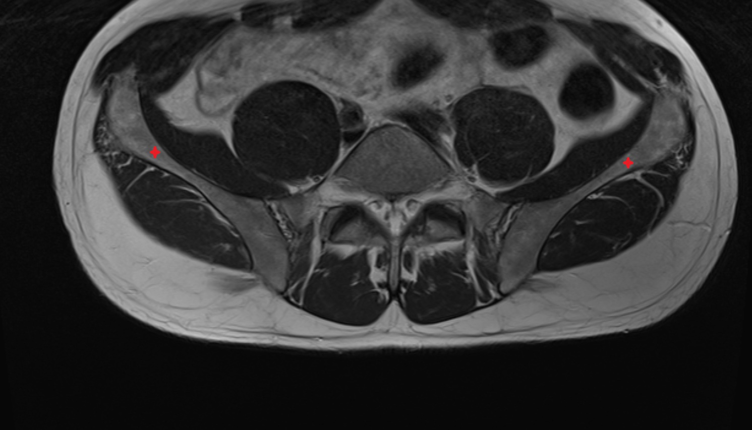 Ala of ilium   MRI axial anatomy  image -img-00000-00000