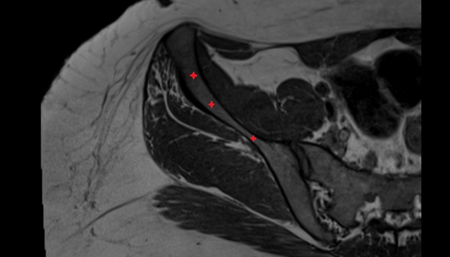Ala of ilium  axial  MRI axial anatomy