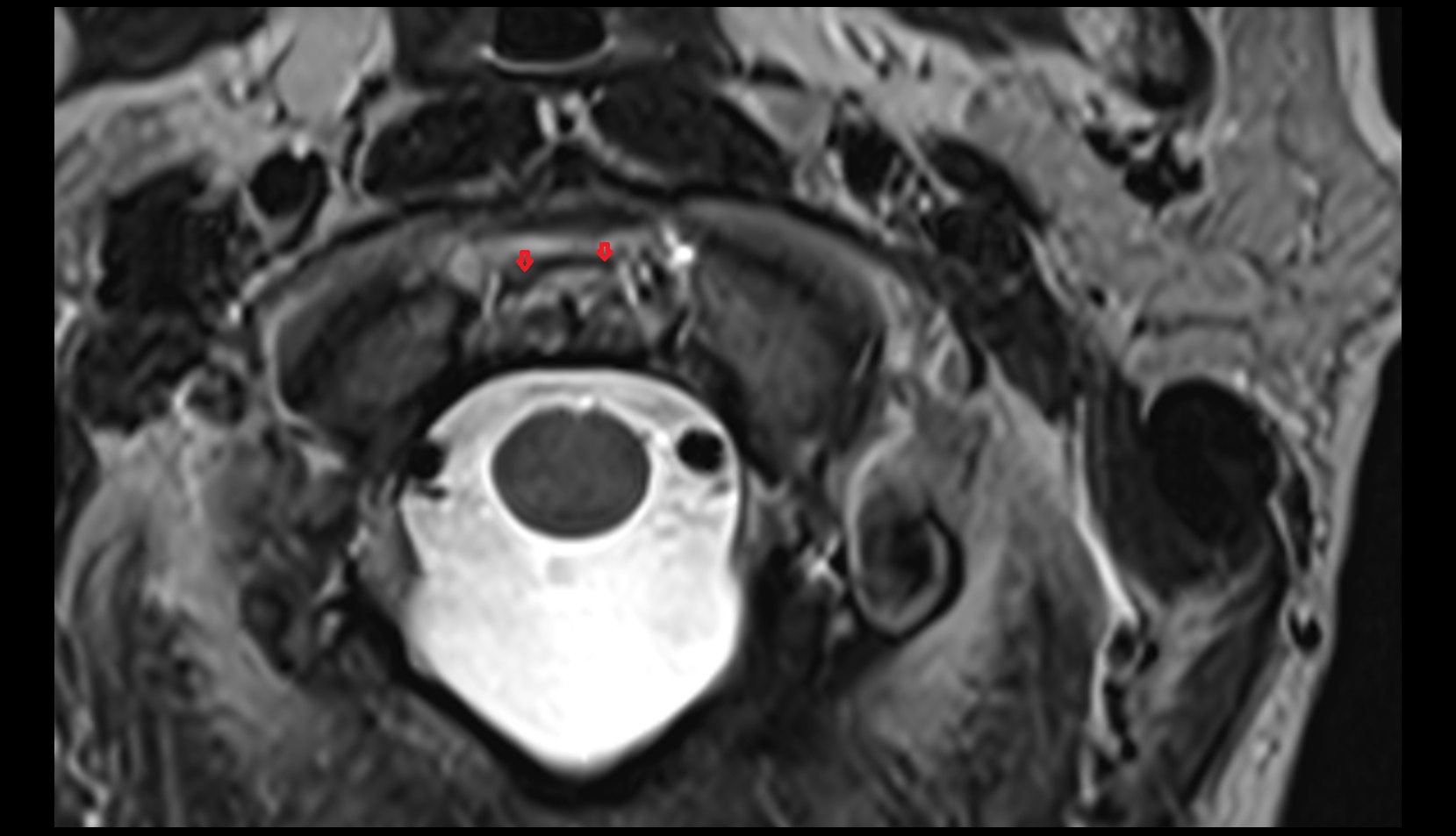 Alar ligament mri axial image