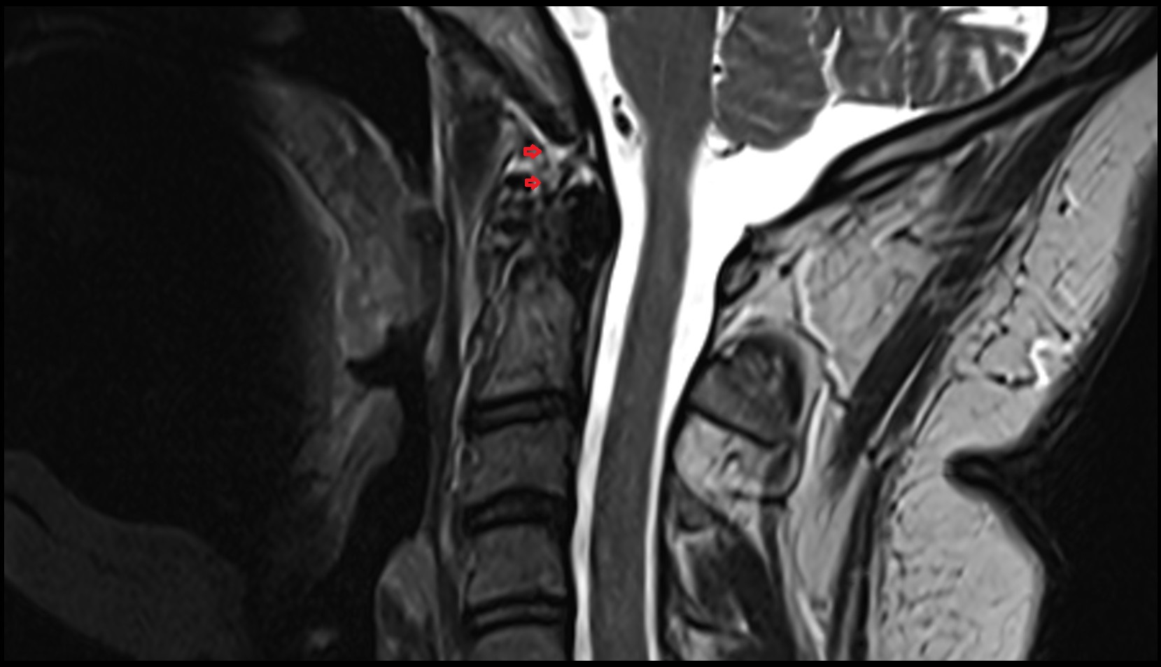 Alar ligament mri sag image