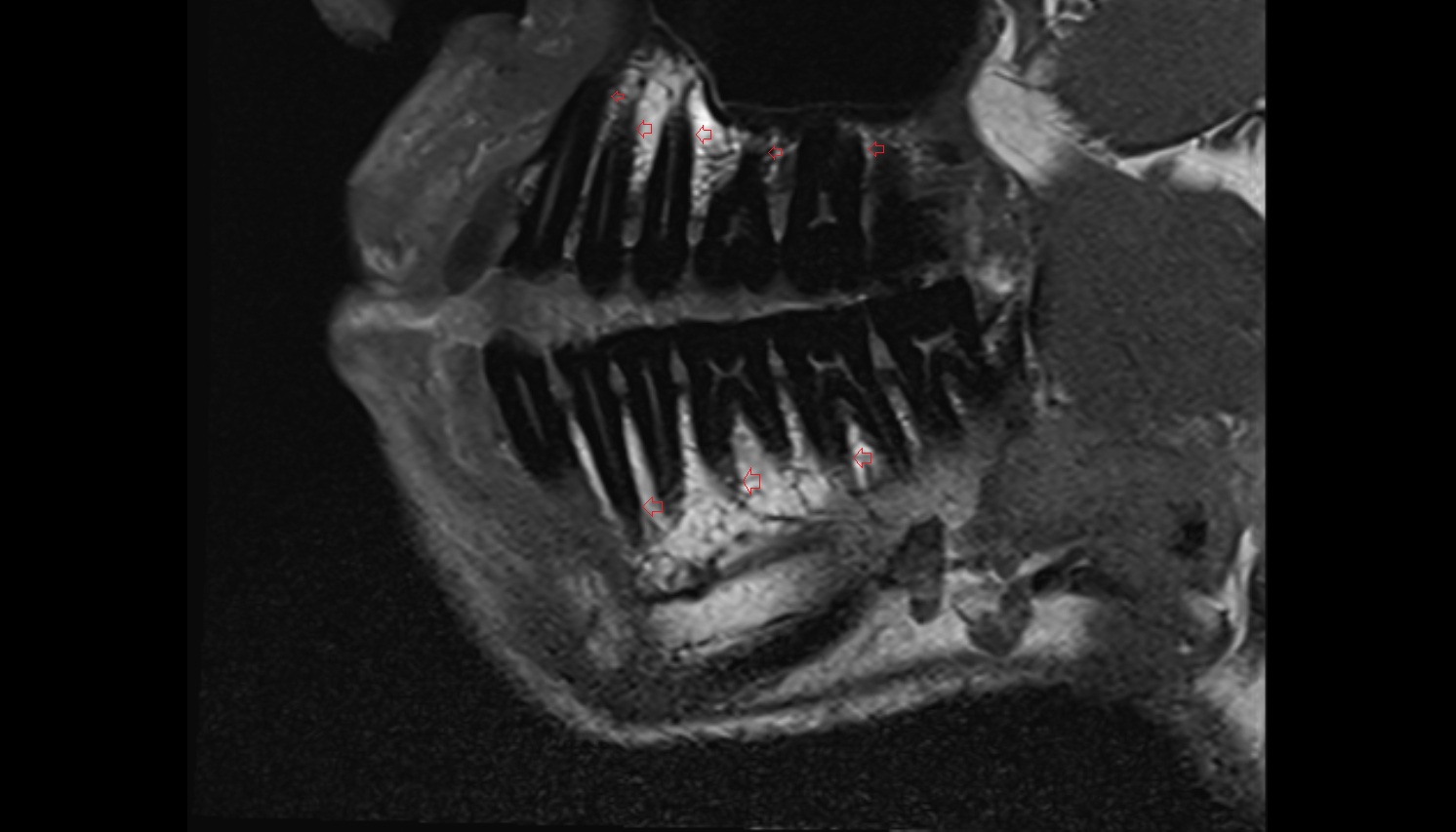 Alveolar Ridge  mri sagittal  image -img-00000-00000