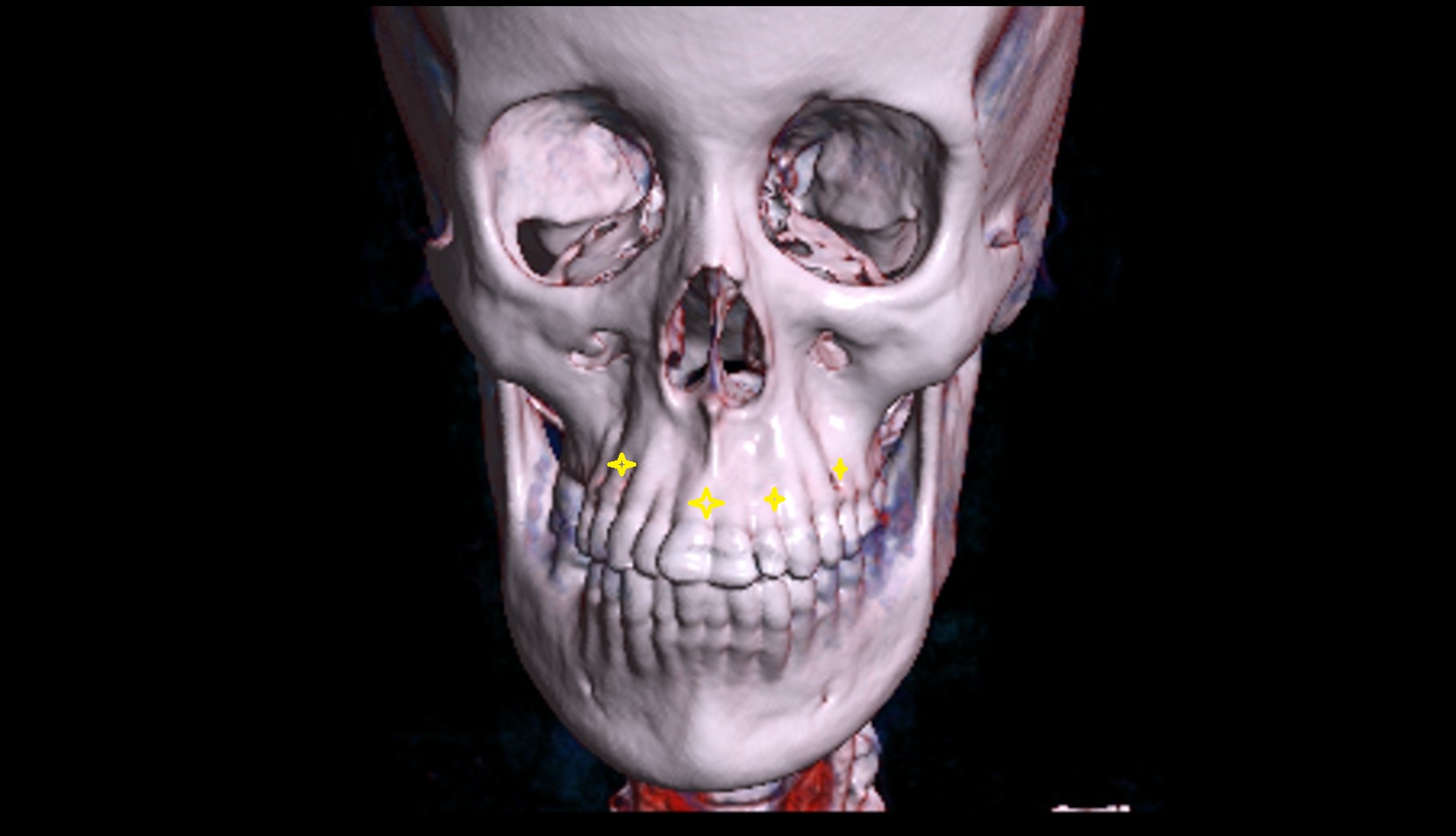 Alveolar arch of maxilla 3D