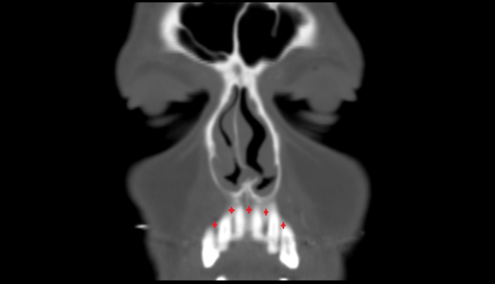 Alveolar process of maxilla CT