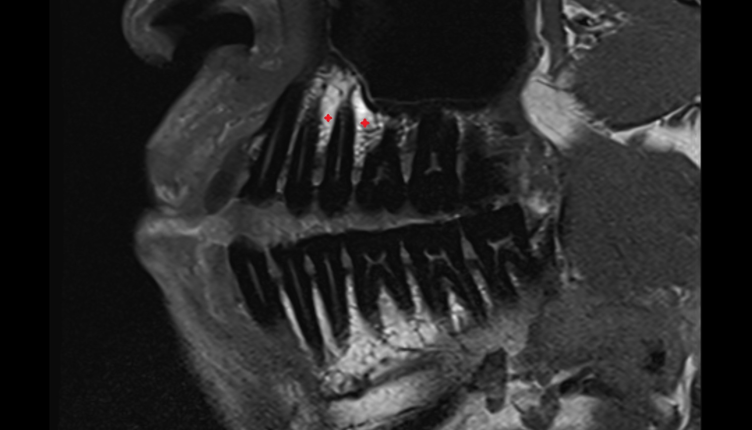 Alveolar process of maxilla mri sagittal  image -img-00000-00000