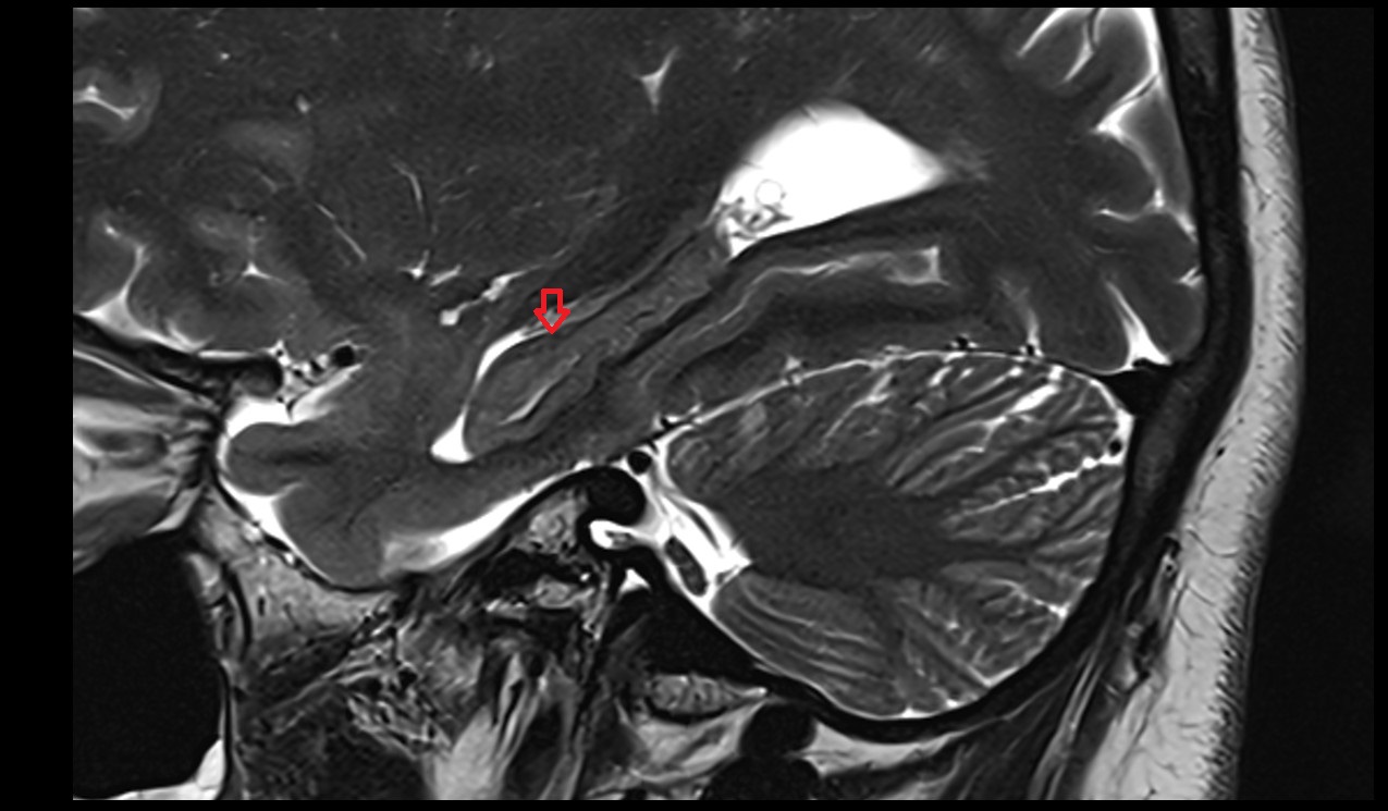 Alveus of hippocampus mri 3t sagittal image