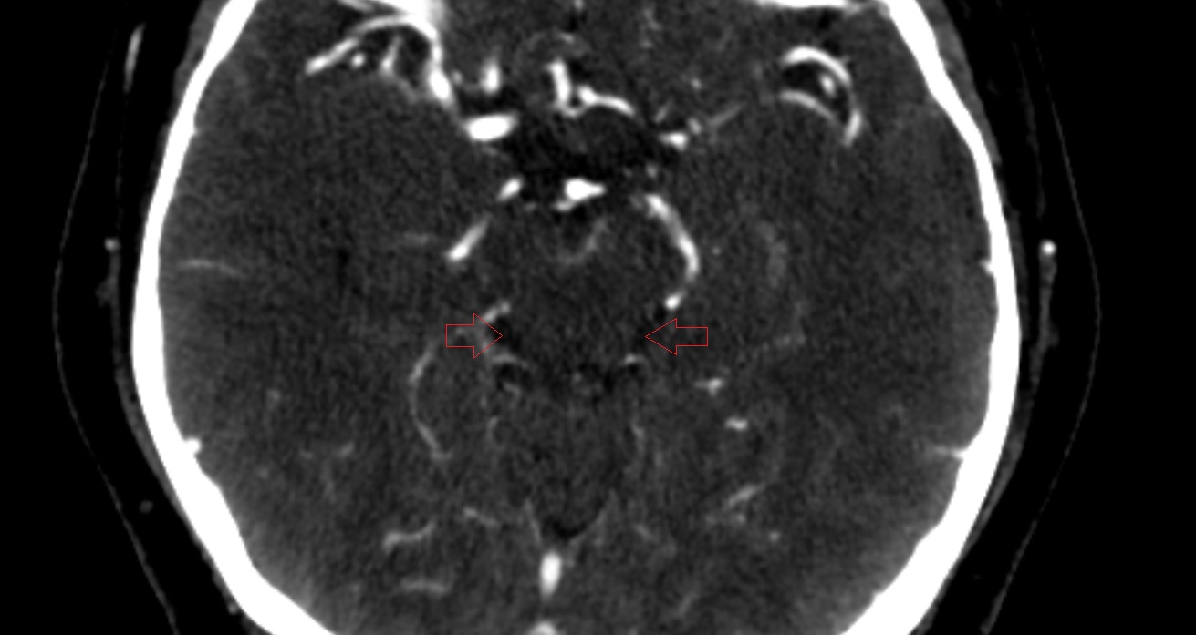 Ambient cistern  CT axial anatomy image -img-00001-00001