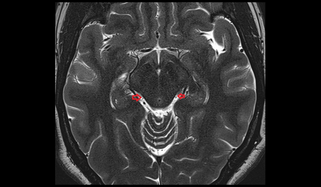 Ambient cistern axial 3t mri image
