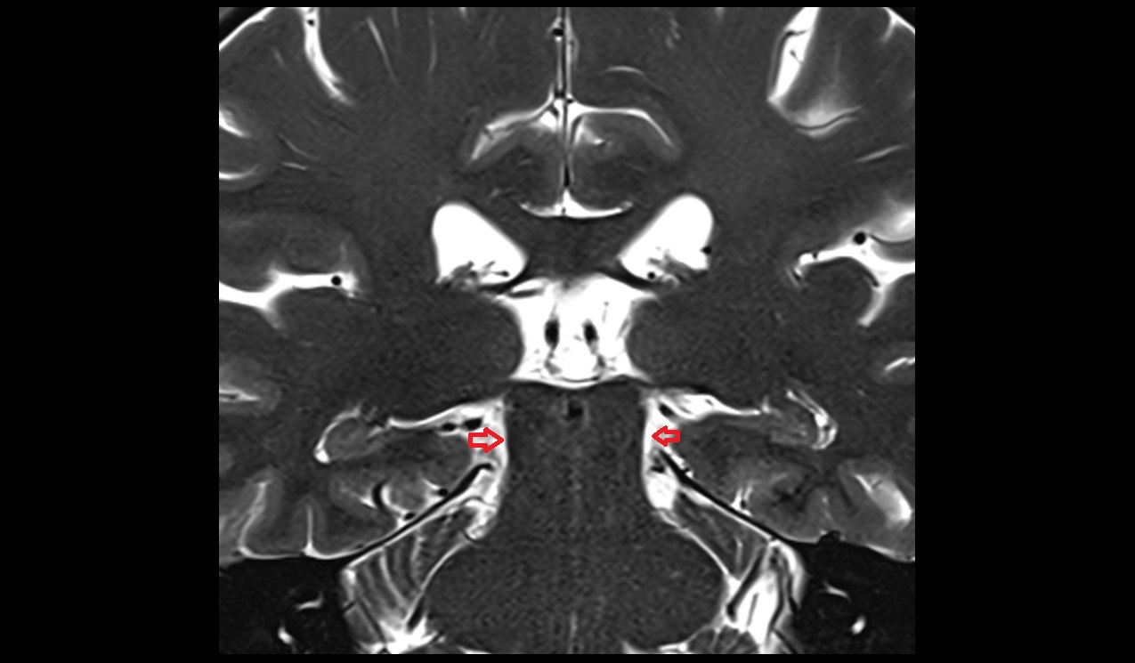 Ambient cistern coronal 3t mri image