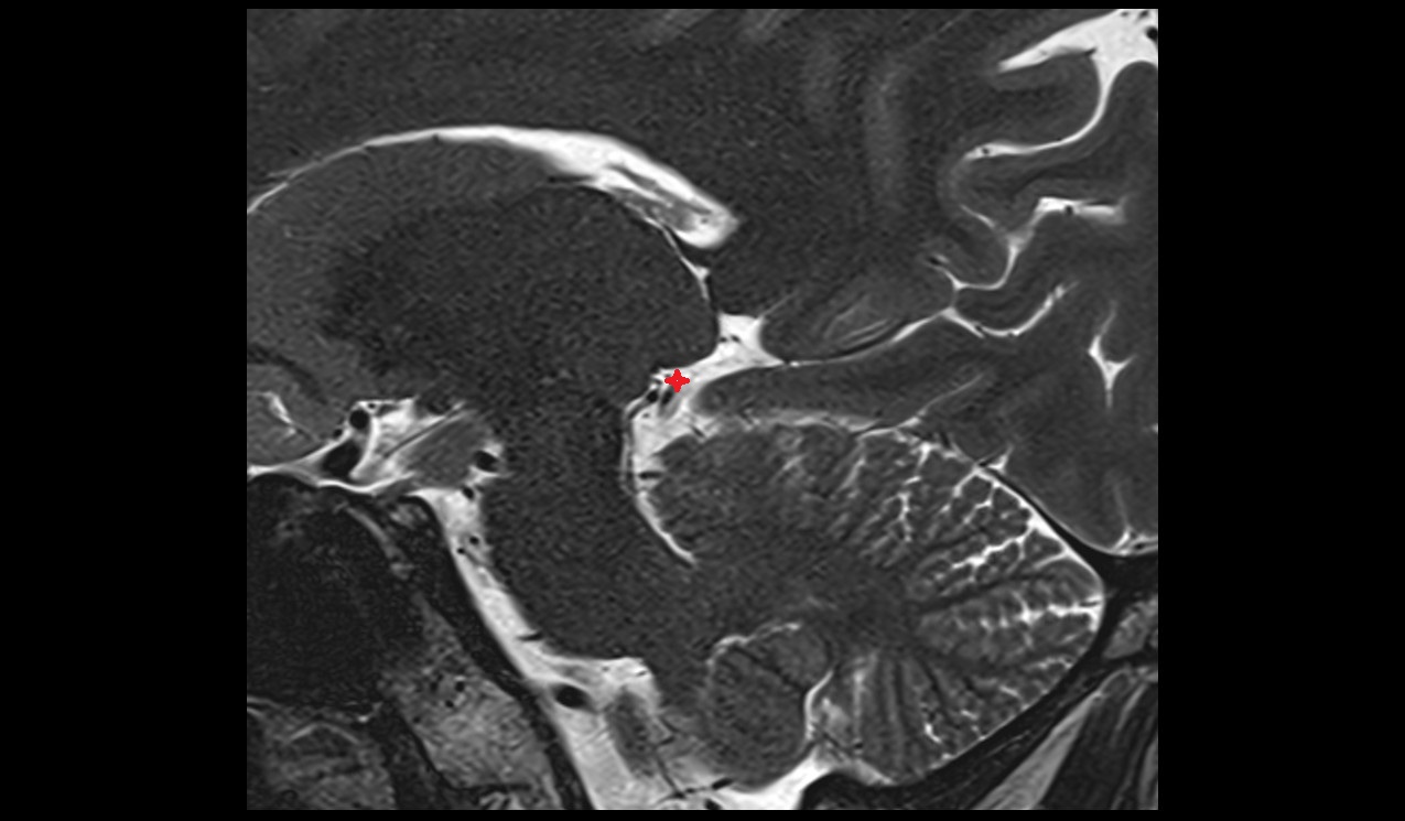 Ambient cistern sagittal 3t mri image
