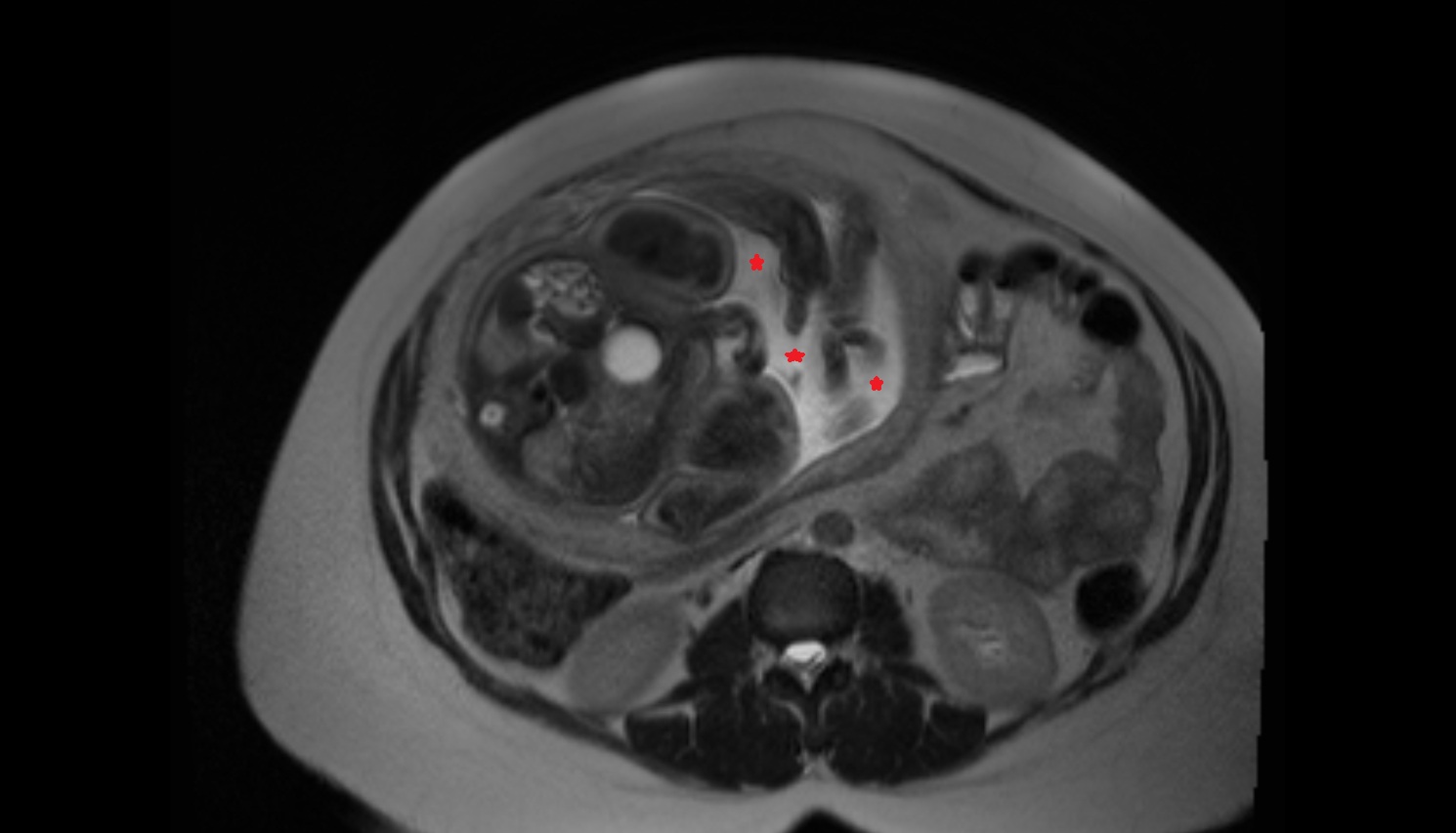 Amniotic fluid  MRI axial  anatomy image-img-00000-00000