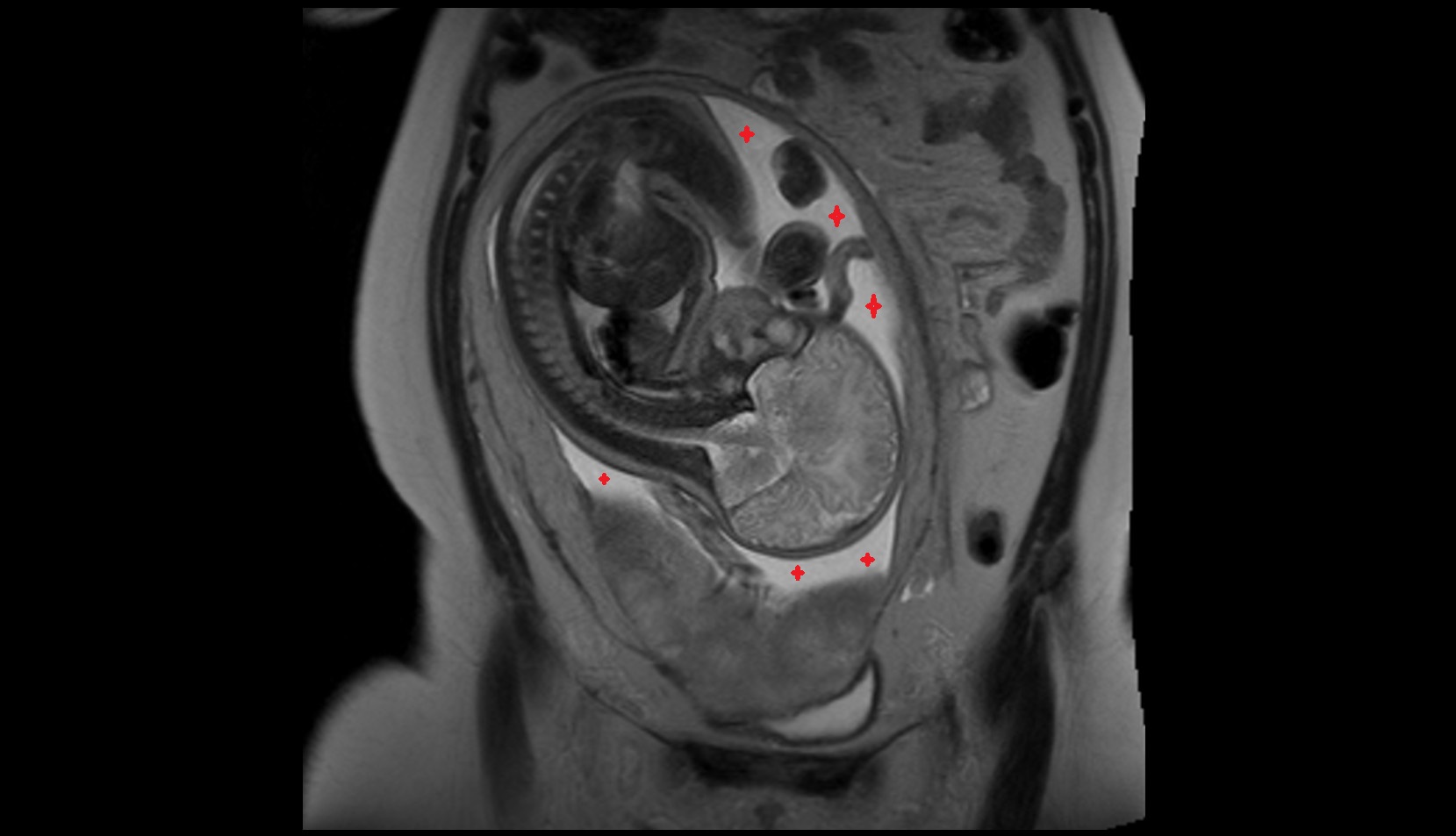 Amniotic fluid mri coronal image
